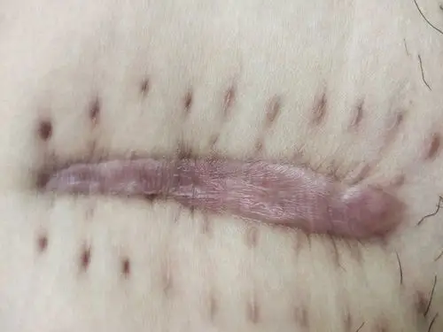 剖腹产后刀口怎么这样了