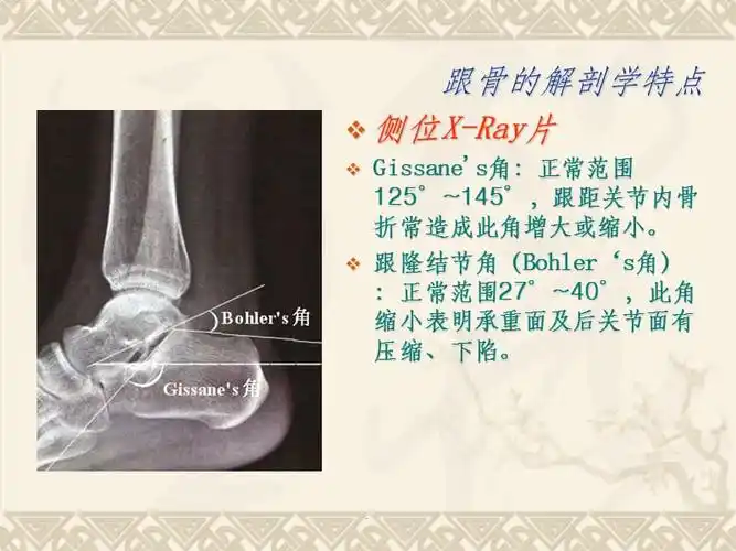 跟骨骨折分型及治疗ppt课件