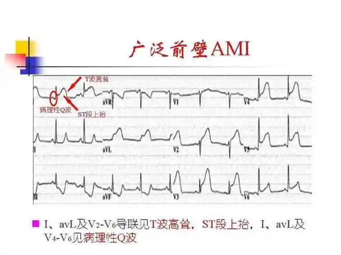 精彩课件丨急诊和夜班必备:心电图危急值识别与处理!