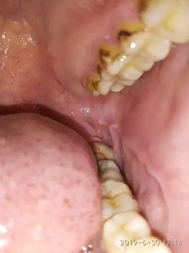 这样的口腔(如下图)是不是咽喉发炎,口腔溃疡,用什么方法可以快速治疗