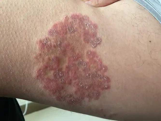 男性患者,大腿根部起红斑,鳞屑10天,涂抹激素药膏后加重.