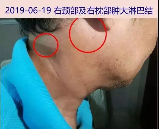 神志清,皮肤巩膜无黄染,右侧颈后部及枕部多发淋巴结增大,部分融合,质