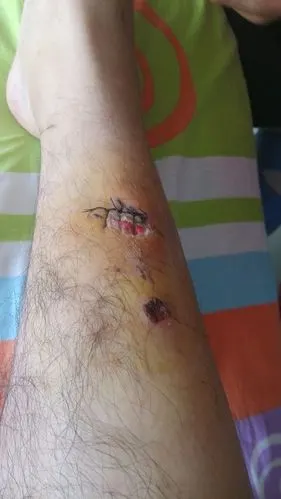 右腿头几天不小心受伤了,缝了几针,今天换药的时候拿纱布把皮带下一块