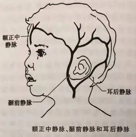 实用经验分享:小儿头皮针穿刺技巧_静脉