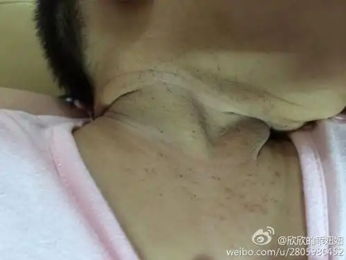 我女儿10个月 脖子上发了好多小黑点 帮忙看下这是