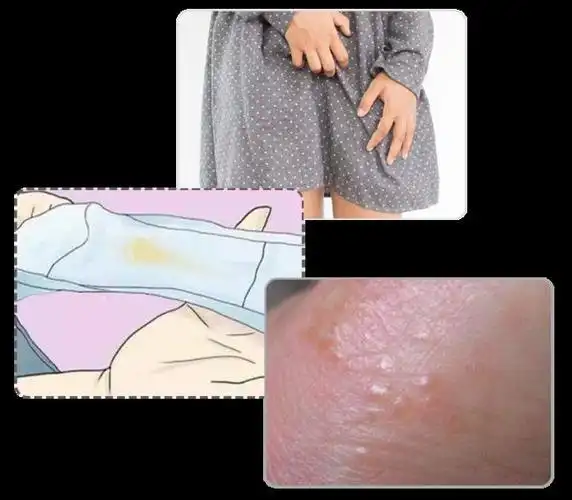 它对赤白带下,阴肿阴痒,湿疹湿疮,皮肤瘙痒,滴虫性阴道炎等症状都很