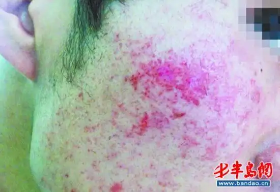 屈臣氏购薇婷脱毛膏致面部过敏 布满红疙瘩