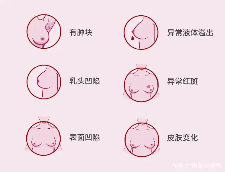关注乳腺癌早筛,提早发现乳腺癌异常症状