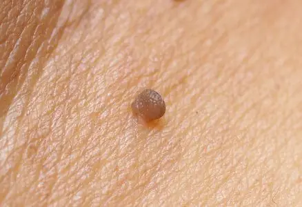 协管瘤白种人皮肤乳头状瘤照片