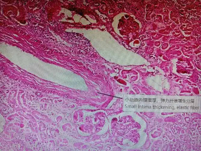 病理组织切片观察六心血管系统疾病下