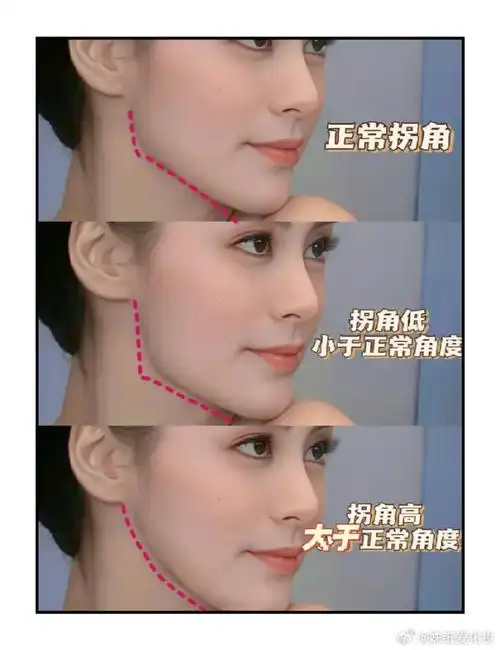 【关于下颌角/颧骨内推审美细节分享】