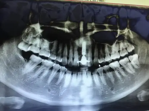 有没有牙科医生帮我看看我的种植牙 牙槽骨吸收情况 植体有问题吗5555
