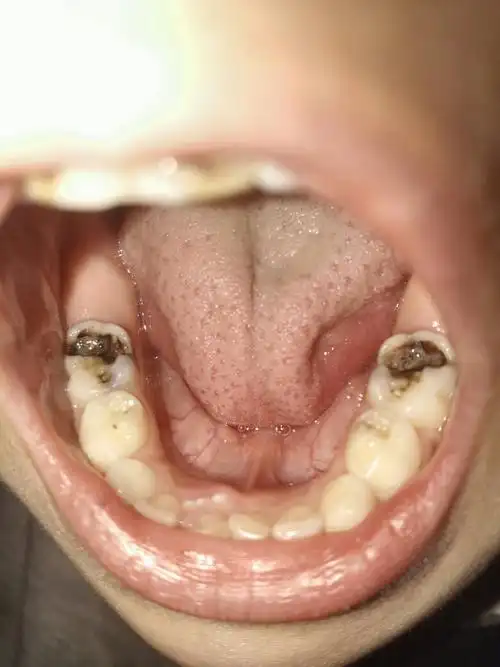 儿子六岁了两个最里面的嗓牙坏了开了洞本以为不疼