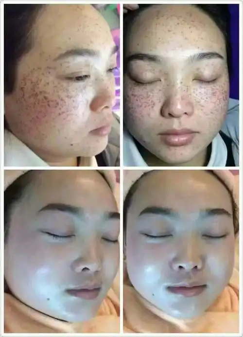 恭喜冰芙洁专业祛斑祛痘黄石分公司直营店开业大吉!