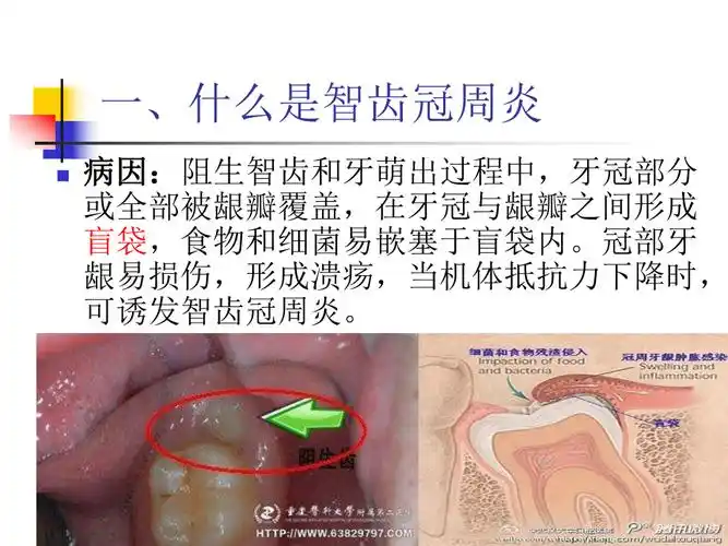 智齿冠周炎课件第四组ppt