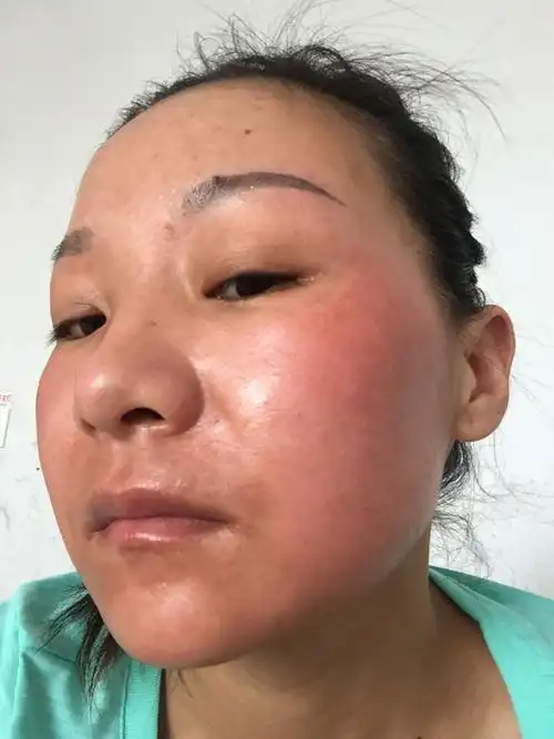 我的脸是9月23日做的液氮冷冻祛斑,涂了两次膜后,2天就形成她们所谓的