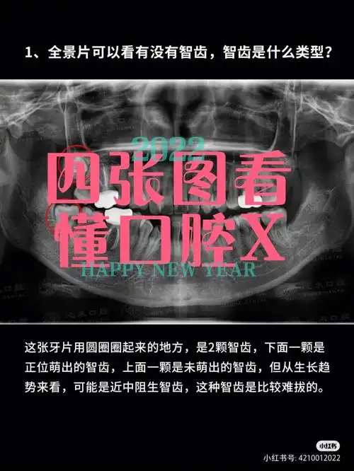 2,全景片判断牙齿的拥挤程度.