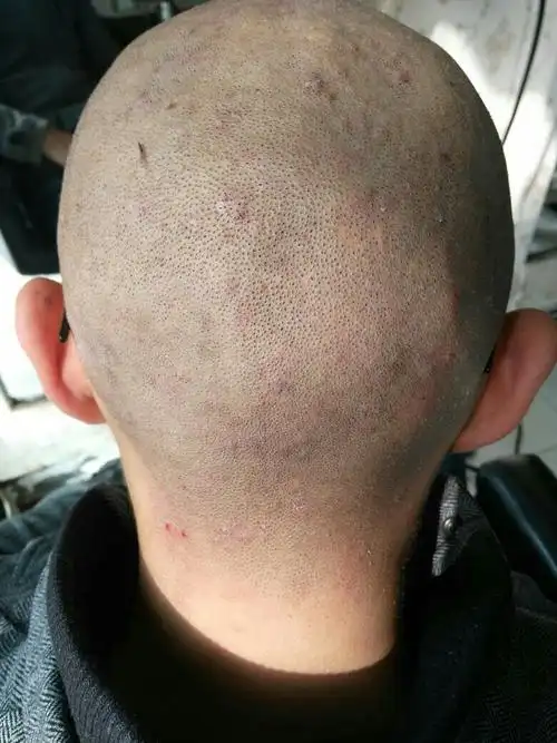 头皮问题,头皮屑比较多,头上好多疙瘩