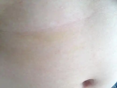 肚皮淤青是怎么回事,刚开始肚皮表面没什么异样,手指按压肚皮有点疼