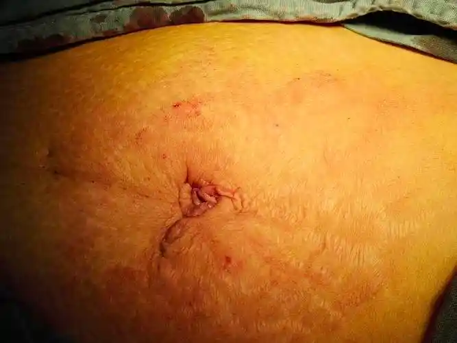 术后缝和,拿着放大镜才能找到手术伤口哦