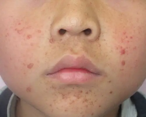 结节性硬化症面部皮损怎么治疗?