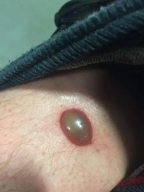 5)·虻叮咬,重口慎入 - 知乎