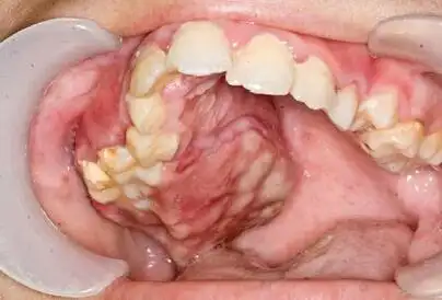 上颌骨中央性肌纤维瘤一例