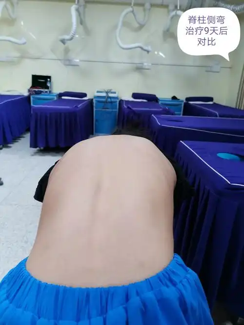 茂林镇卫生院中医康复科关注儿童,青少年脊柱侧弯健康,我们一直努力着