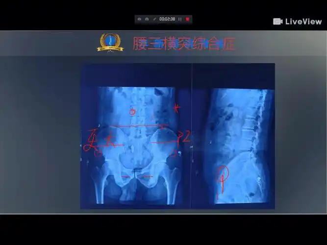腰三横突综合症