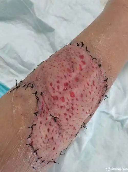 小腿后侧组织缺损vsd辅助游离植皮