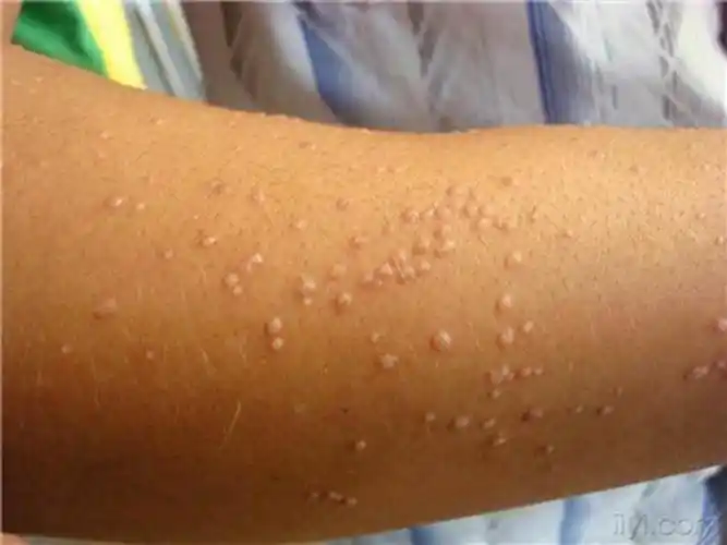 眼部皮肤丝状疣的图片