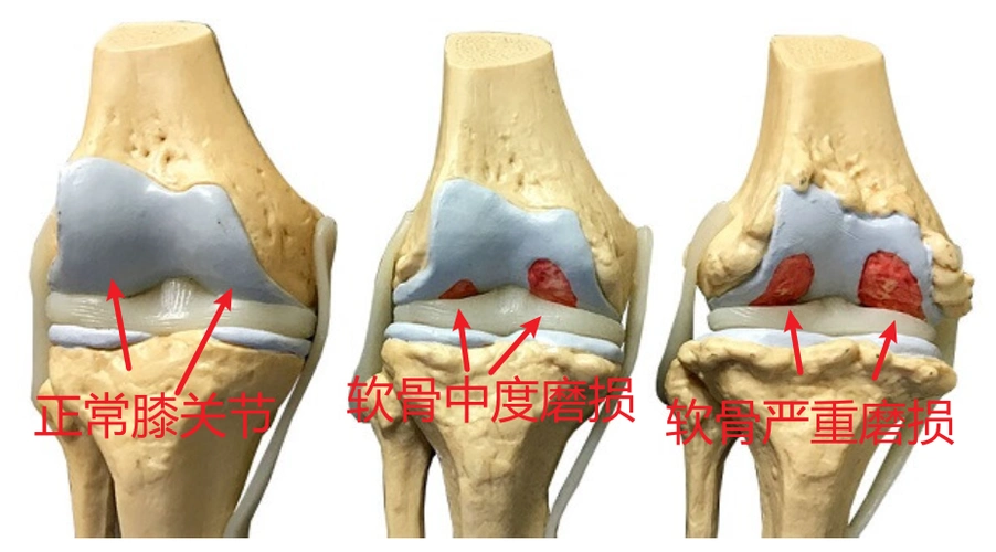 老人家膝关节长骨刺了该怎么办
