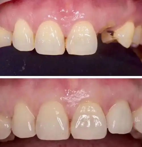 纯钛烤瓷牙优缺点都有哪些?