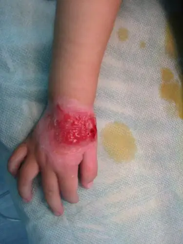 儿童手背植皮术后2年对比_杨明忠