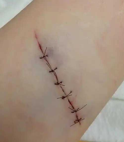 缝针和拆线可怕吗疼吗你们当时怕吗