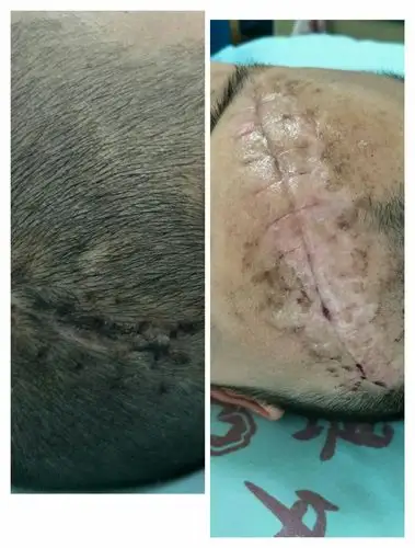 手术操作;结合我院目前条件下能够开展:脑出血(外伤,高血压)开颅血肿