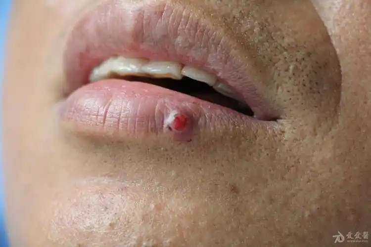 化脓性肉芽肿一例. - 皮肤及性传播疾病讨论版 - 爱爱医医学论坛