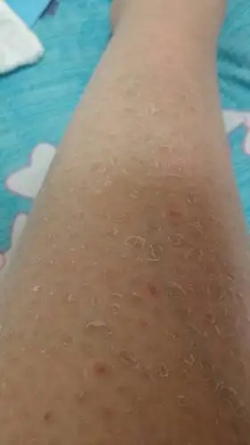 推荐于2017-08-30 19:02:05   最佳答案 毛周角化症,这个没有根治的