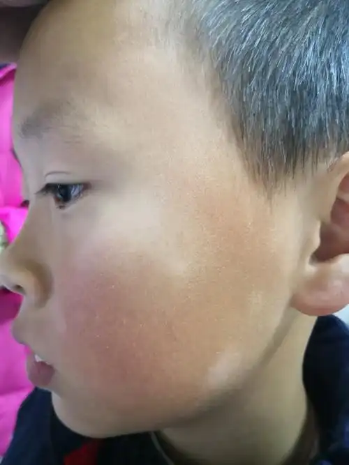 白色糠疹科普_白色糠疹_介绍_治疗方式_日常注意事项 - 好大夫在线