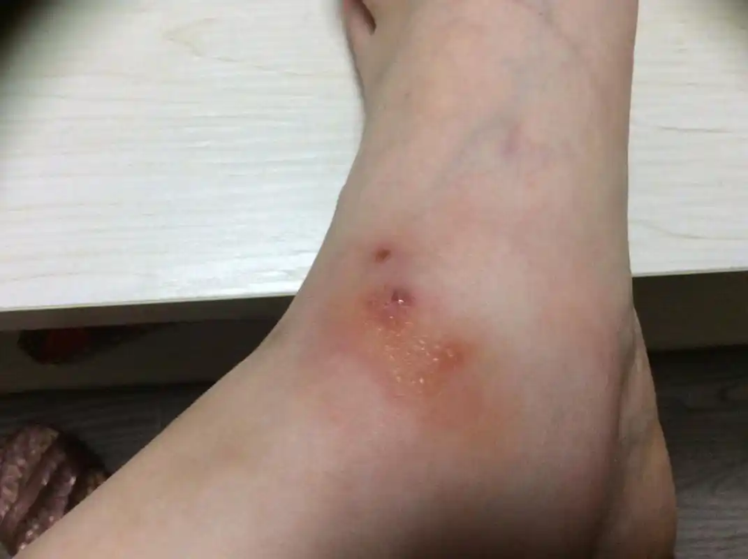 孩子被蜱虫咬霸气爸爸的三个坚决救了娃医生做得好