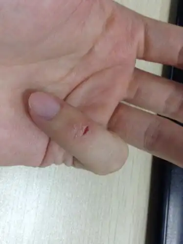 小手指手指开裂很疼痒,怎么办