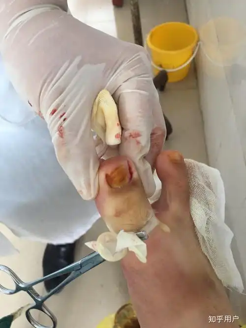 甲沟炎拔甲是怎样的体验? - 知乎