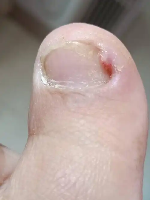 是什么东西旁边是息肉吗  还是什么 左侧指甲发黄  是真菌性甲沟炎吗