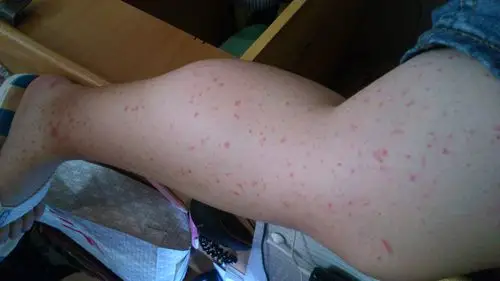腿上会长这种红点,但是不痛也不痒,过一段时间自己会消失,但是过段