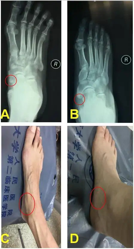 什么是足的副舟骨?为什么老是会疼痛? - 好大夫在线