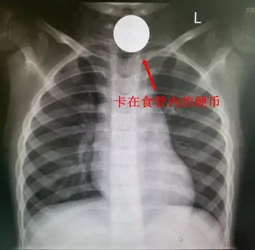 幼儿误吞硬币入食管,医生"取钱有术"_误吞异物