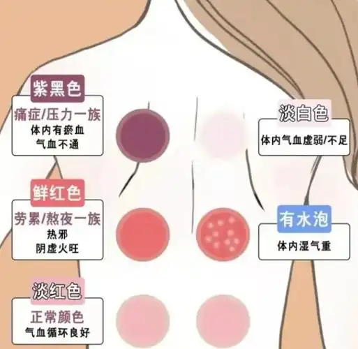 拔罐能排毒?提醒:并非人人都适合