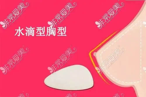 水滴型胸型示意图