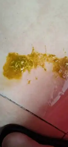 三个月宝宝,拉大便有条状奶瓣是怎么回事?