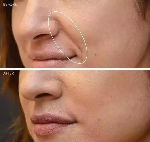 鼻子两侧八字纹很深怎么消除(让.女人夜夜疯狂的神器)